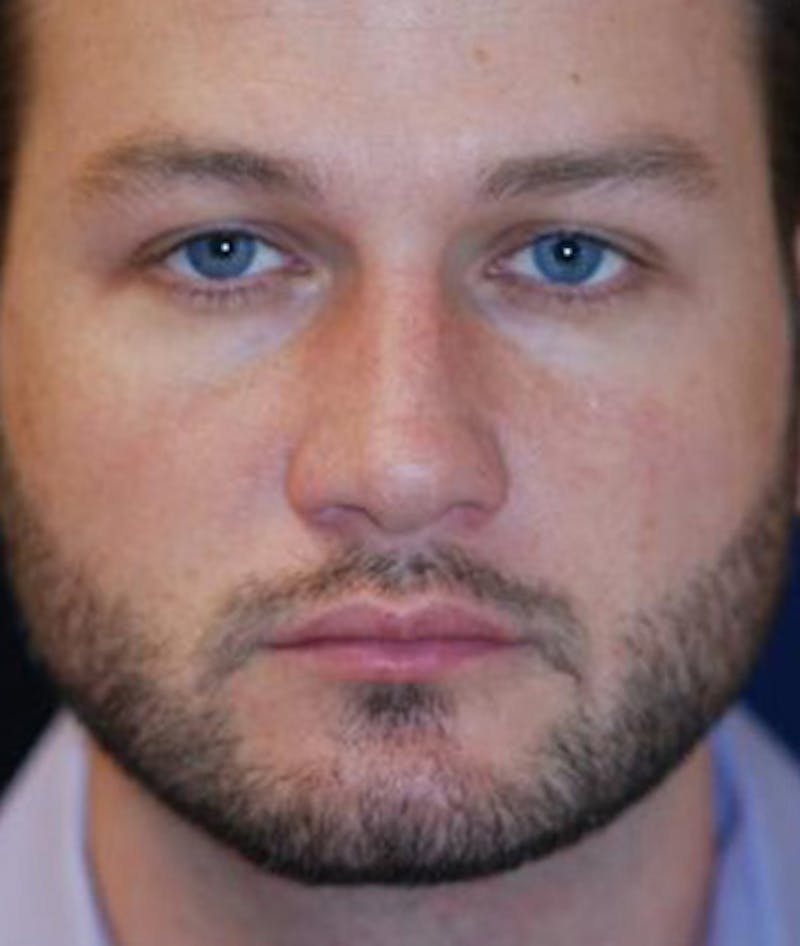 Chin Augmentation Before & After Gallery - Patient 291159 - Image 2