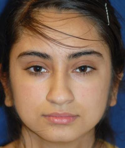 Ear Pinning (Otoplasty) Before & After Gallery - Patient 119510 - Image 2
