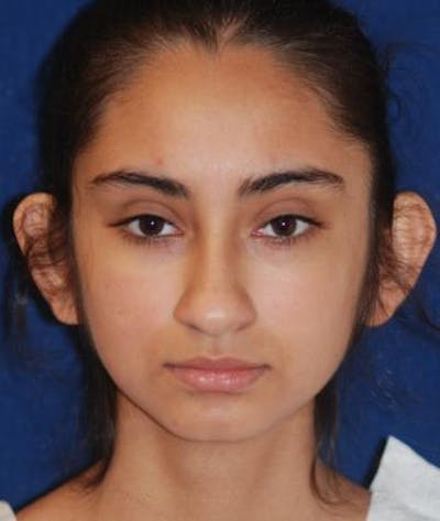 Ear Pinning (Otoplasty) Before & After Gallery - Patient 119510 - Image 1