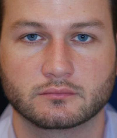 Chin Augmentation Before & After Gallery - Patient 291159 - Image 1