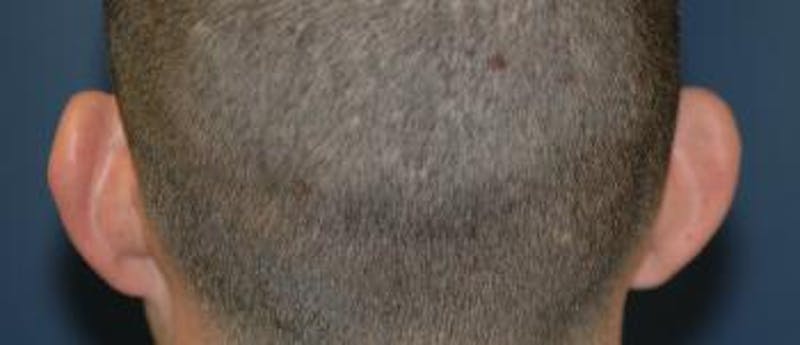 Ear Pinning (Otoplasty) Before & After Gallery - Patient 175948 - Image 3