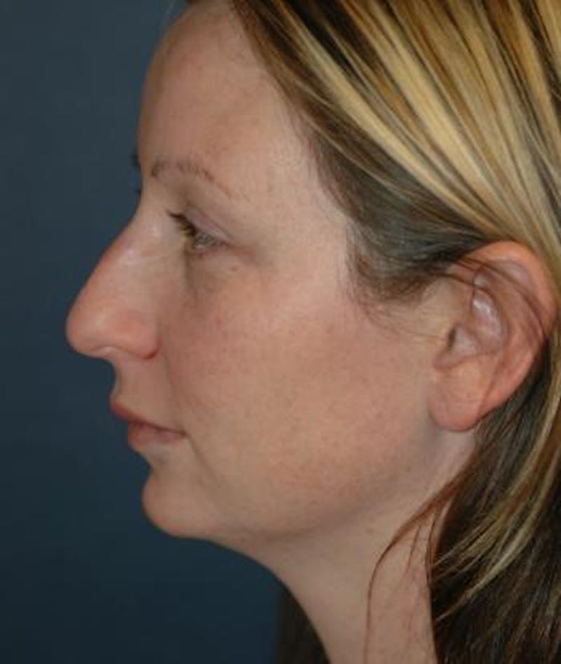 Chin Augmentation Before & After Gallery - Patient 135184 - Image 3