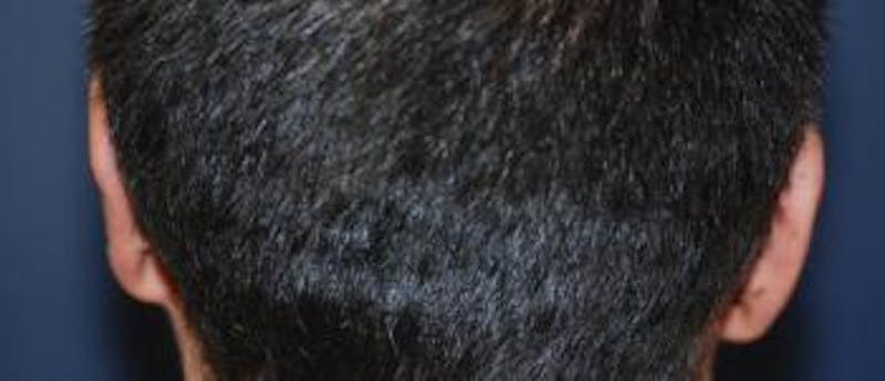 Ear Pinning (Otoplasty) Before & After Gallery - Patient 175948 - Image 4