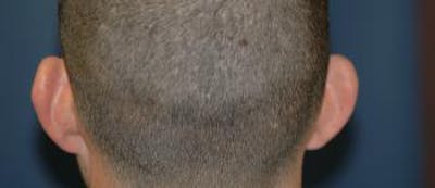 Ear Pinning (Otoplasty) Before & After Gallery - Patient 162290 - Image 1