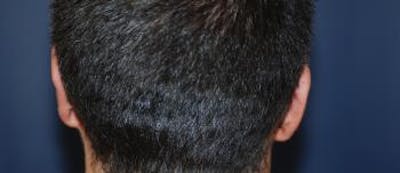 Ear Pinning (Otoplasty) Before & After Gallery - Patient 162290 - Image 2