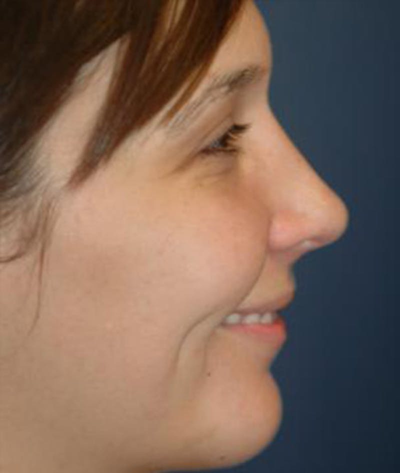 Chin Augmentation Before & After Gallery - Patient 158507 - Image 4