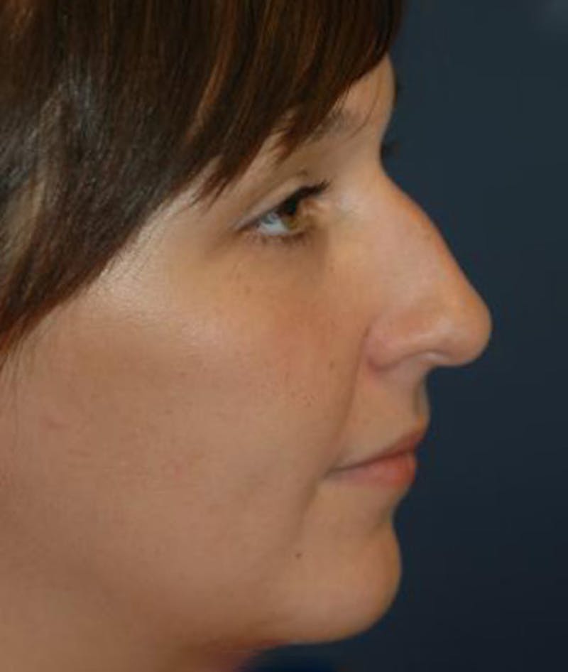 Chin Augmentation Before & After Gallery - Patient 158507 - Image 3