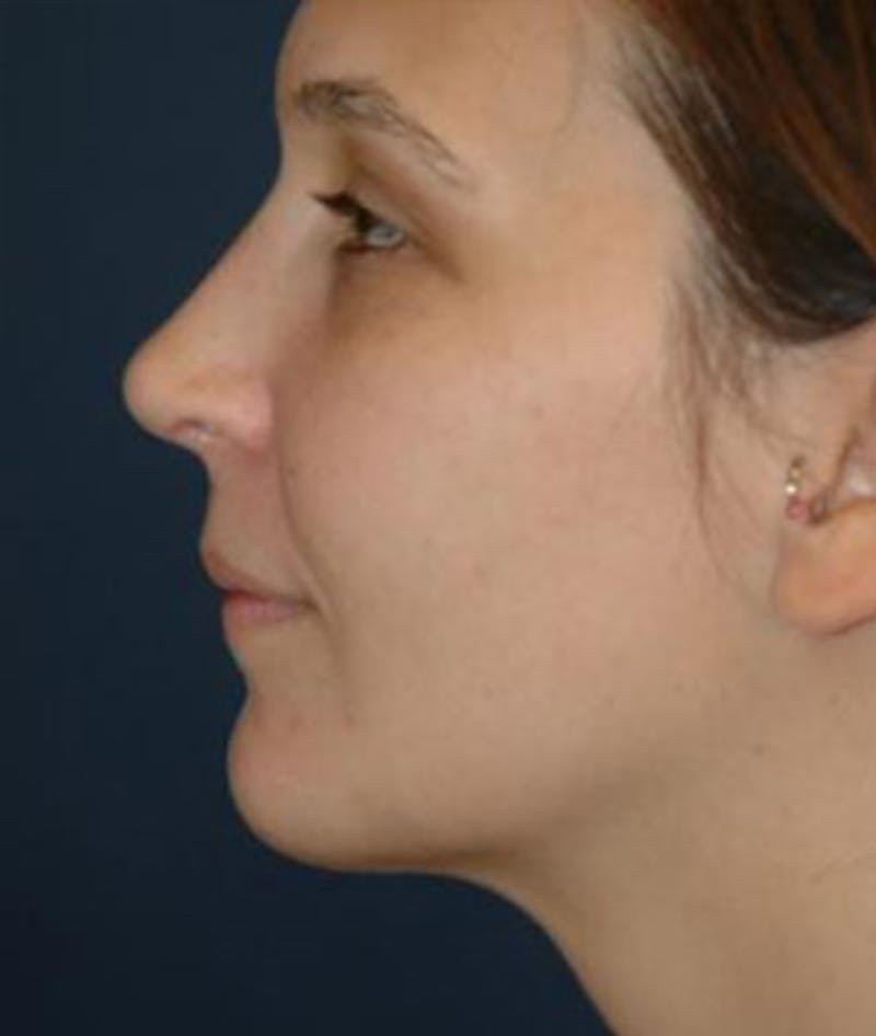 Chin Augmentation Before & After Gallery - Patient 158507 - Image 2