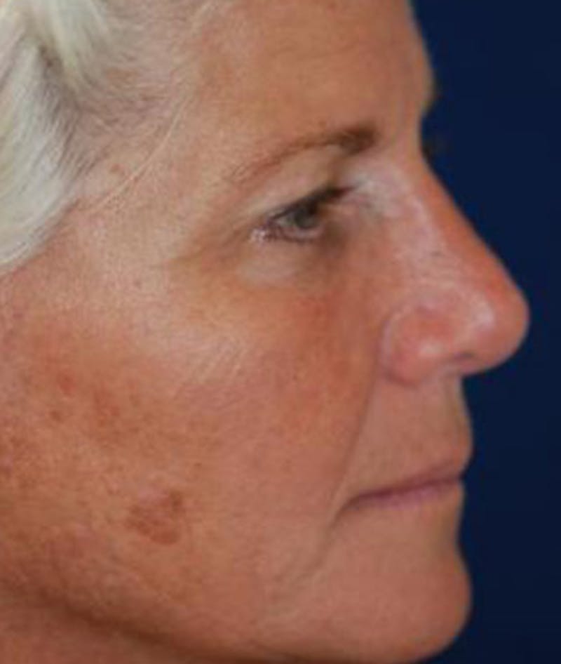 Browlift Before & After Gallery - Patient 169693 - Image 4