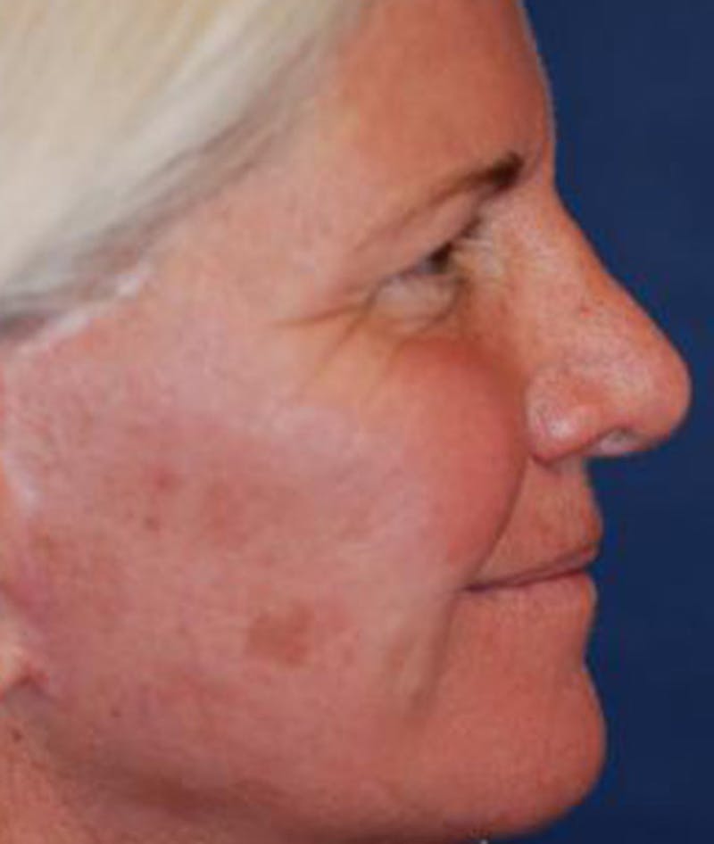 Browlift Before & After Gallery - Patient 169693 - Image 3