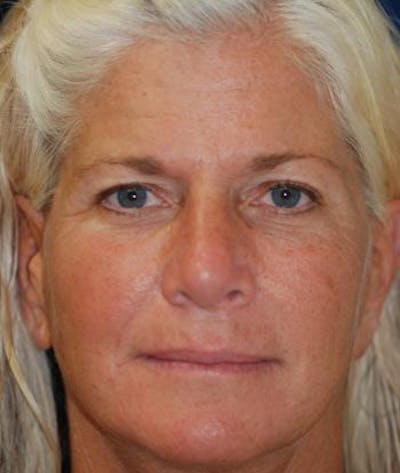Browlift Before & After Gallery - Patient 169693 - Image 2