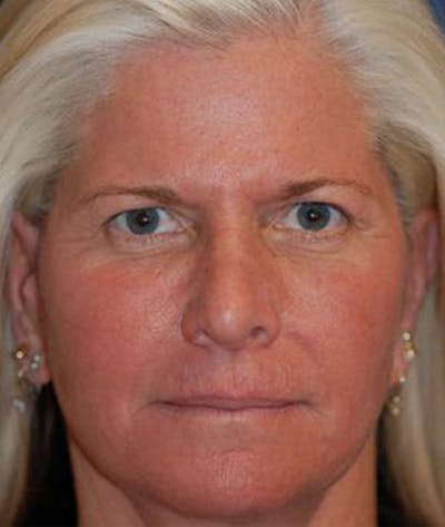 Browlift Before & After Gallery - Patient 169693 - Image 1