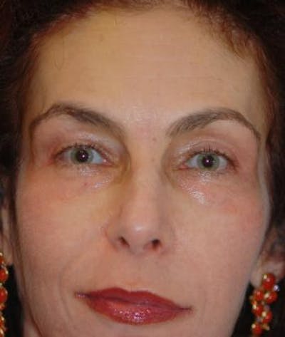Browlift Before & After Gallery - Patient 102307 - Image 2