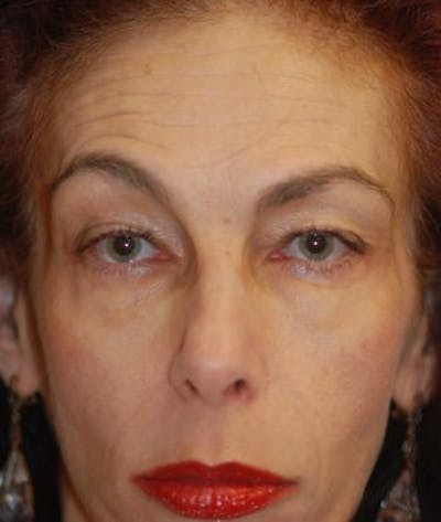 Browlift Before & After Gallery - Patient 102307 - Image 1