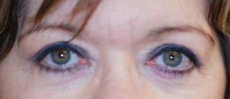 Browlift Before & After Gallery - Patient 315816 - Image 4