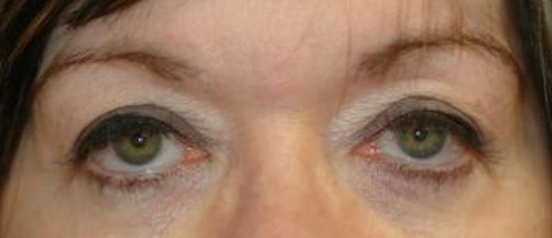 Browlift Before & After Gallery - Patient 315816 - Image 3