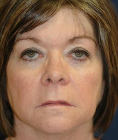 Browlift Before & After Gallery - Patient 315816 - Image 1