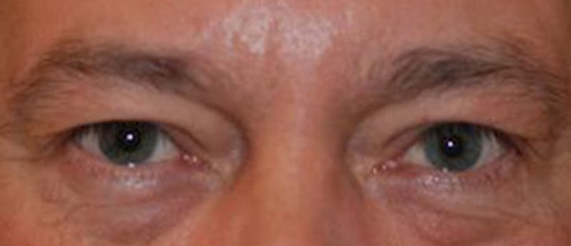 Browlift Before & After Gallery - Patient 952245 - Image 4