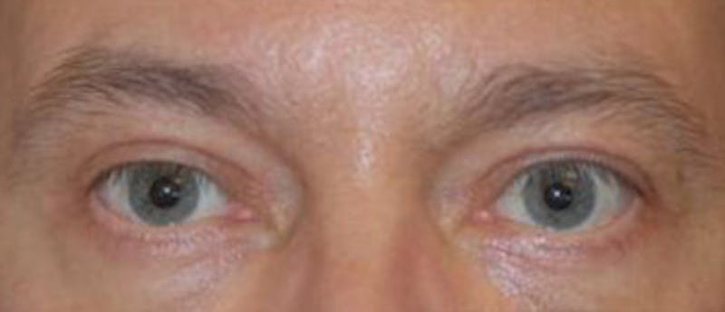 Browlift Before & After Gallery - Patient 952245 - Image 3