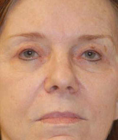 Browlift Before & After Gallery - Patient 419731 - Image 2