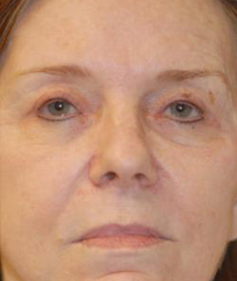 Browlift Before & After Gallery - Patient 419731 - Image 2