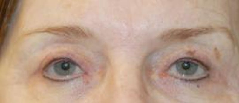Browlift Before & After Gallery - Patient 419731 - Image 4