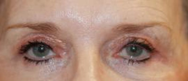 Browlift Before & After Gallery - Patient 419731 - Image 3