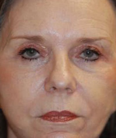 Browlift Before & After Gallery - Patient 419731 - Image 1