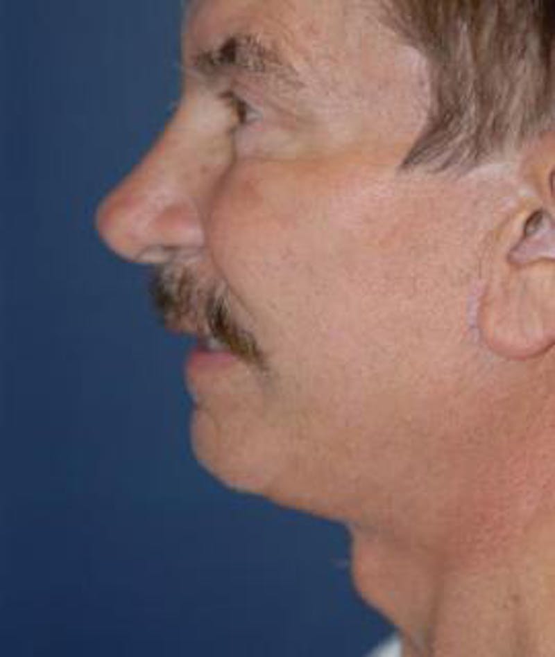 Browlift Before & After Gallery - Patient 944668 - Image 4