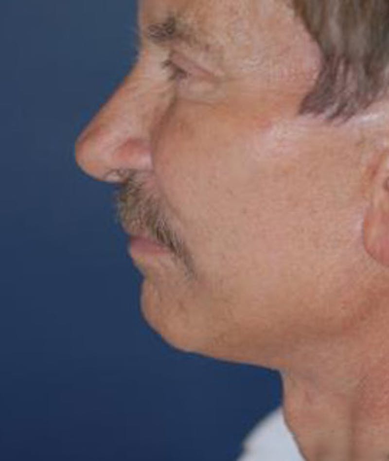 Browlift Before & After Gallery - Patient 944668 - Image 3