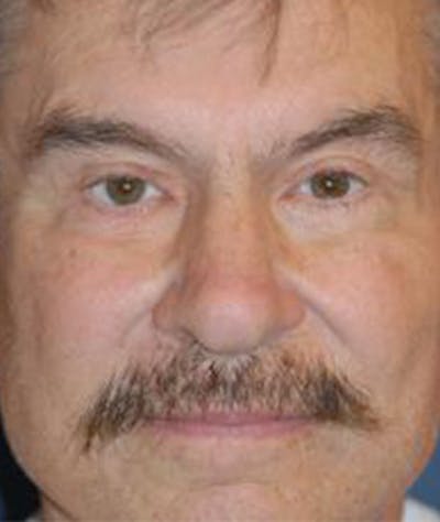 Browlift Before & After Gallery - Patient 944668 - Image 2