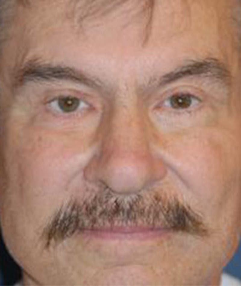 Browlift Before & After Gallery - Patient 944668 - Image 2