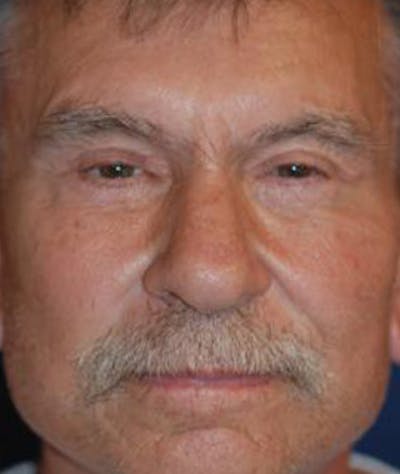 Browlift Before & After Gallery - Patient 944668 - Image 1
