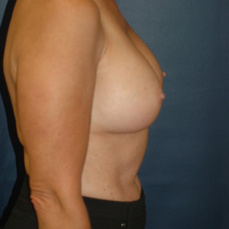 Breast Augmentation Before & After Gallery - Patient 161318 - Image 4