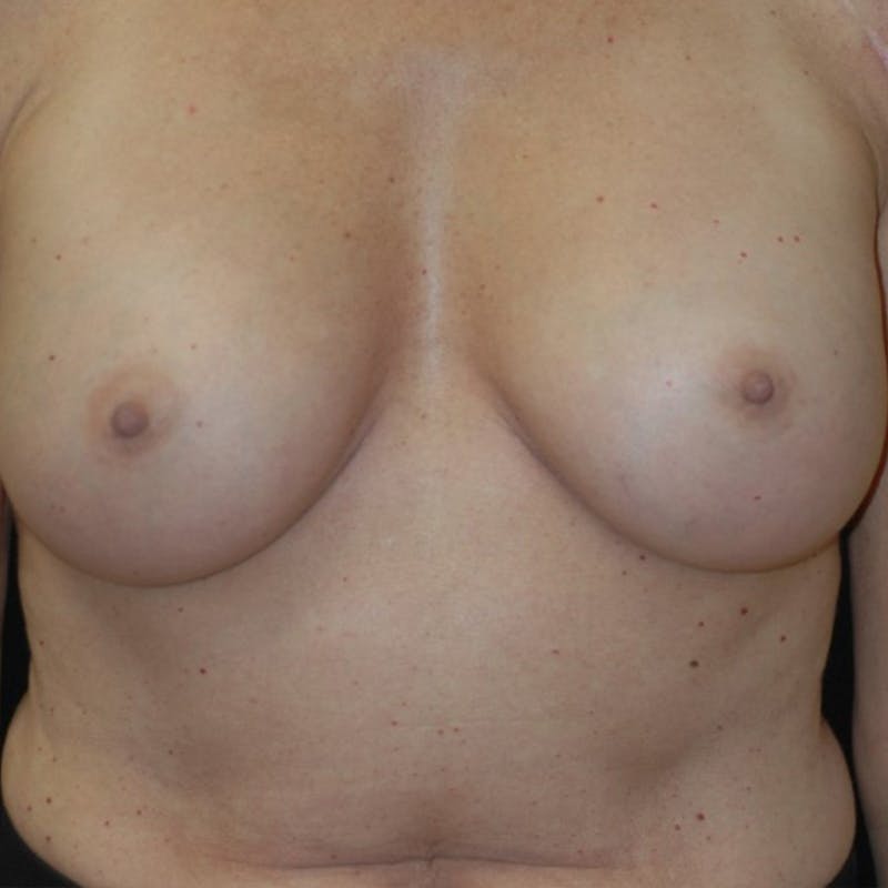 Breast Augmentation Before & After Gallery - Patient 161318 - Image 2