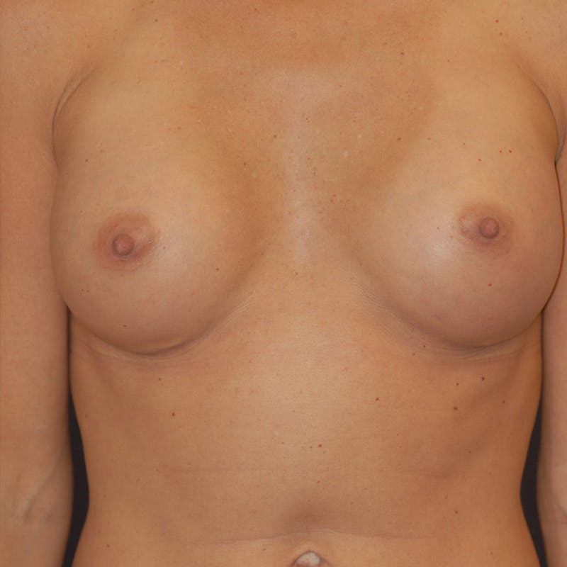 Breast Augmentation Before & After Gallery - Patient 186701 - Image 2