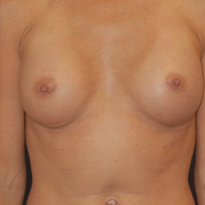 Breast Augmentation Before & After Gallery - Patient 186701 - Image 2