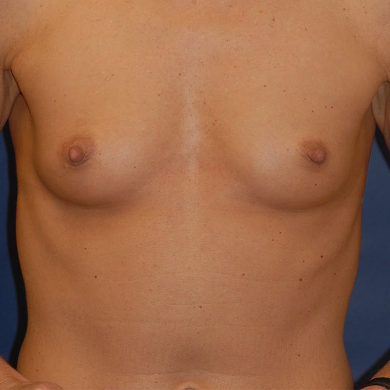 Breast Augmentation Before & After Gallery - Patient 186701 - Image 1