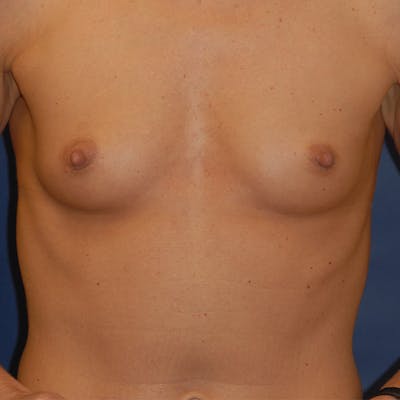 Breast Augmentation Before & After Gallery - Patient 186701 - Image 1