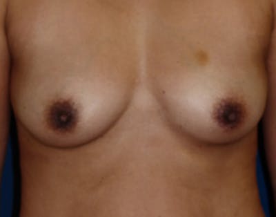 Breast Augmentation Before & After Gallery - Patient 186081 - Image 1