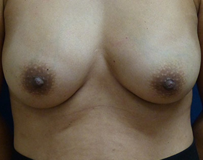 Breast Augmentation Before & After Gallery - Patient 186081 - Image 2