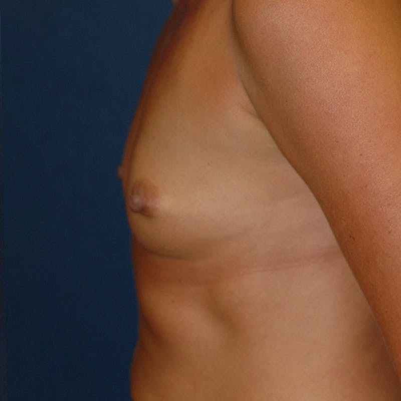Breast Augmentation Before & After Gallery - Patient 920800 - Image 5