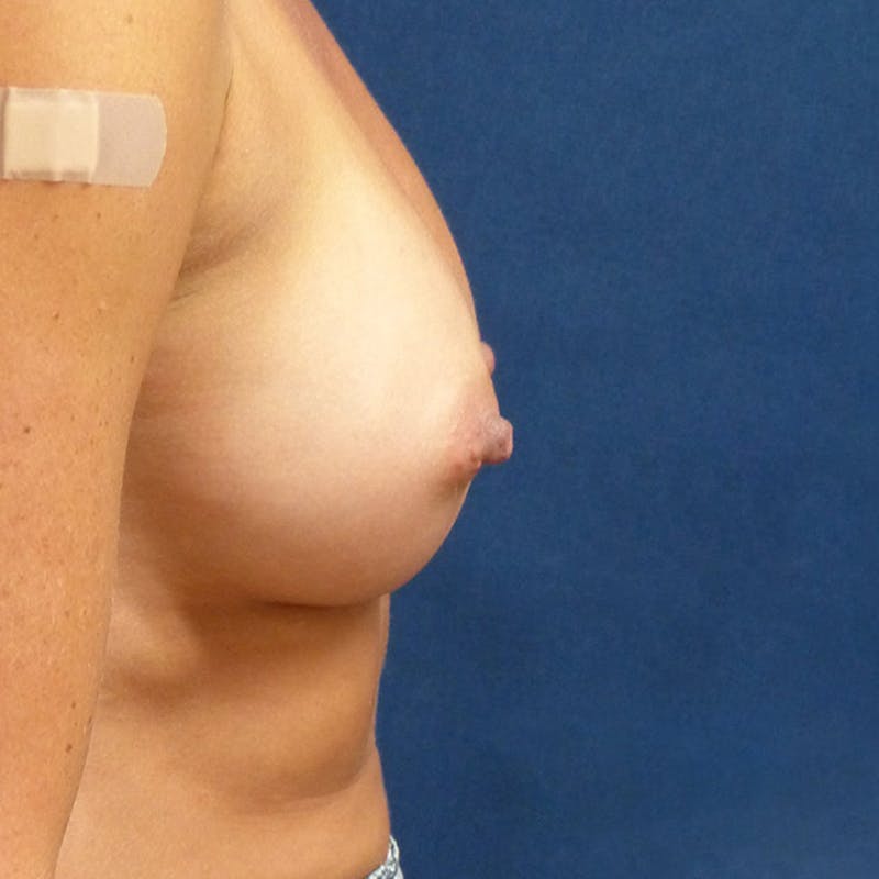 Breast Augmentation Before & After Gallery - Patient 920800 - Image 4