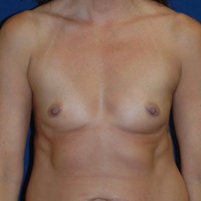 Breast Augmentation Before & After Gallery - Patient 920800 - Image 1