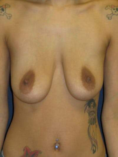Breast Augmentation Before & After Gallery - Patient 212551 - Image 1