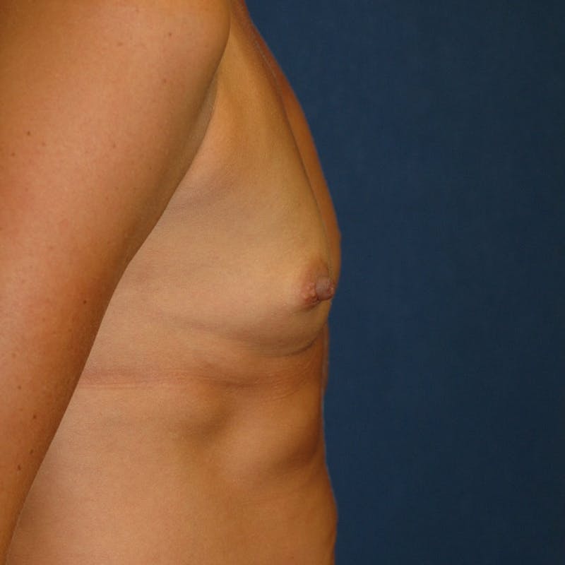 Breast Augmentation Before & After Gallery - Patient 920800 - Image 3