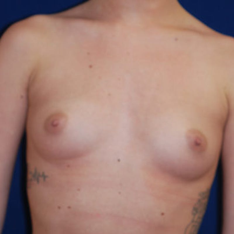 Breast Augmentation Before & After Gallery - Patient 133632 - Image 3