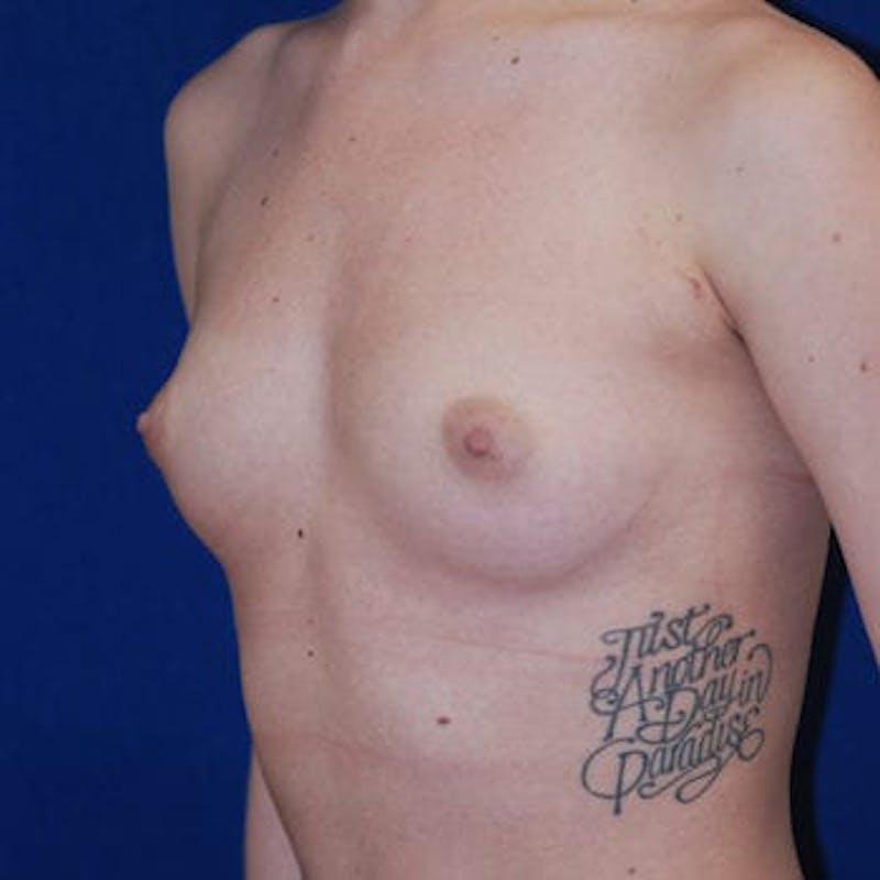 Breast Augmentation Before & After Gallery - Patient 133632 - Image 1