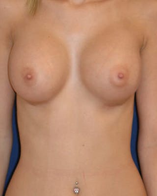 Breast Augmentation Before & After Gallery - Patient 106356 - Image 2