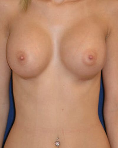 Breast Augmentation Before & After Gallery - Patient 106356 - Image 2